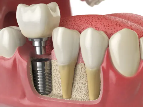 Ilustración en corte: el tornillo de titanio dentro del hueso, con la encía alrededor y la corona encima, entre dos dientes naturales