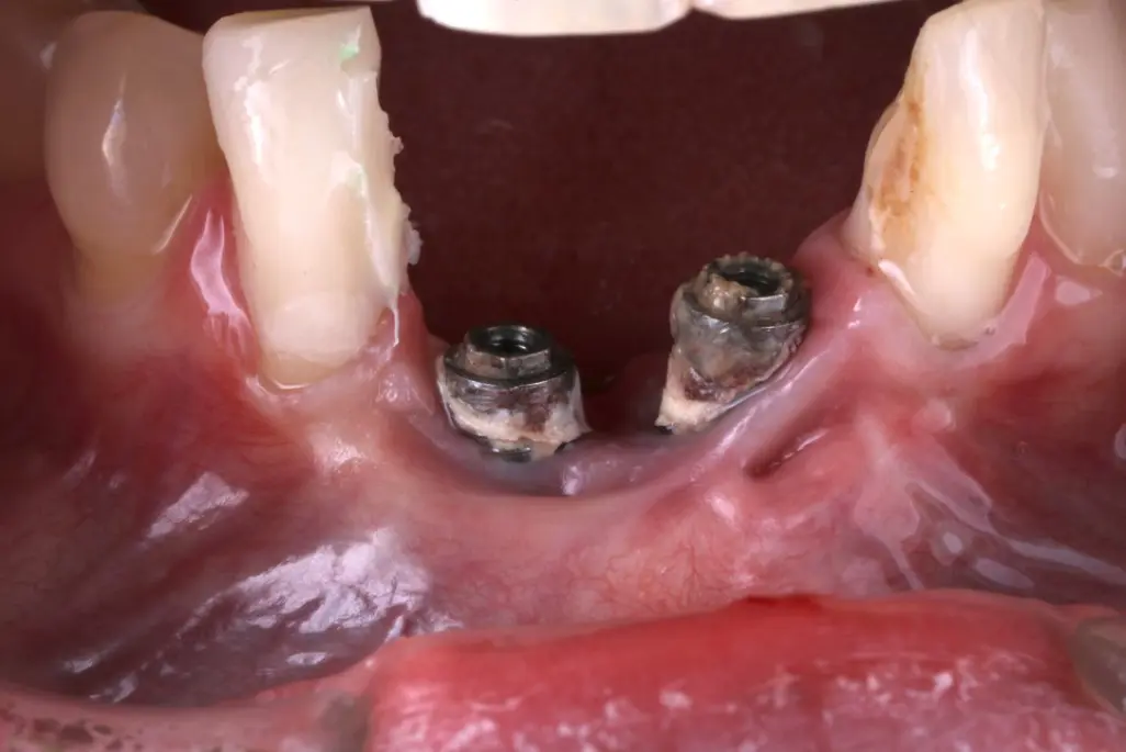 Foto intraoral del frente de arriba: dos implantes a la vista, sin encía ni hueso que los cubra