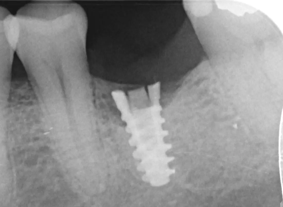 Radiografía del mismo implante con el hueso de alrededor ya perdido